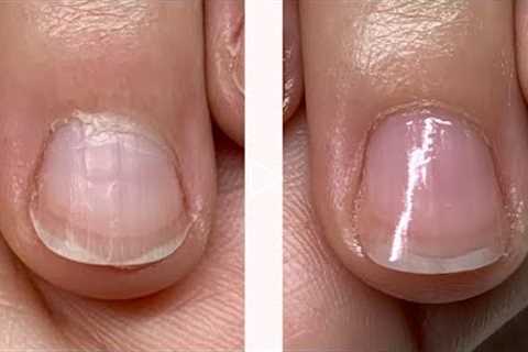 OVERGROWN CUTICLE or STRETCHED PROXIMAL NAIL FOLD? 2 WEEK PROGRESS [WATCH ME WORK]