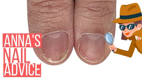 SHOULD I COVER THIS NAIL DAMAGE? [ANNA'S NAIL ADVICE]