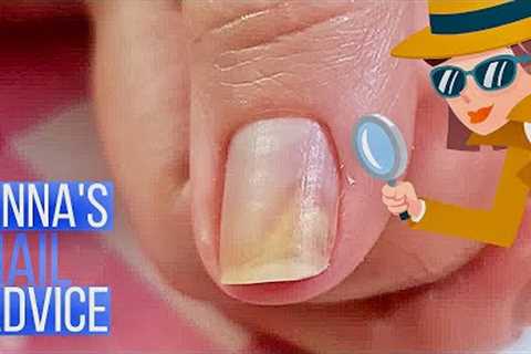 Why Does Nail Separate | Causes | Early Treatment of Onycholysis [Anna''s Nail Advice]