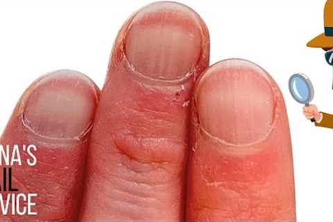 Getting impatient with THIS SKIN around the nails?